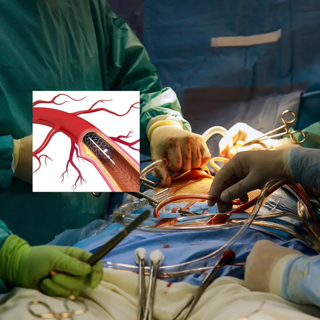 stent coronarico mini-guida